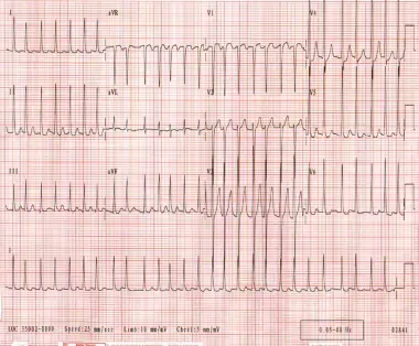 Atrial Fibrillation Market