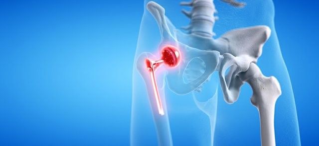 Marché des implants médicaux