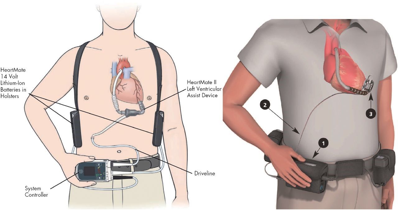 Ventricular Assist Devices Market