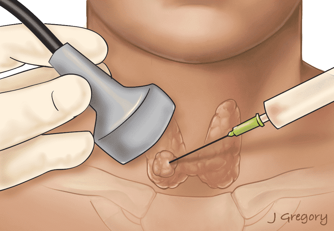 Aspiration & Biopsy Needles Market