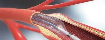 Vascular Stent Market