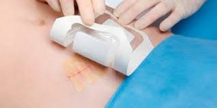 Medical Foam Market